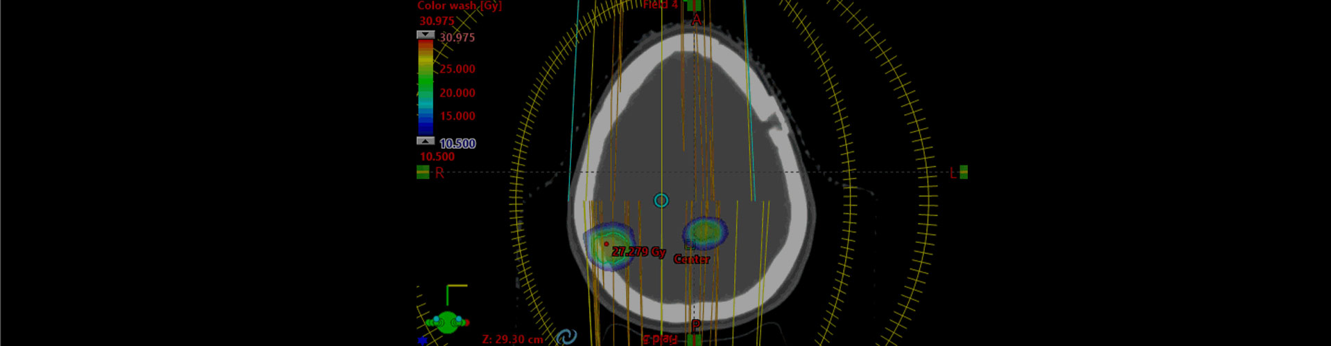 SRS (Stereotactic Radiosurgery)